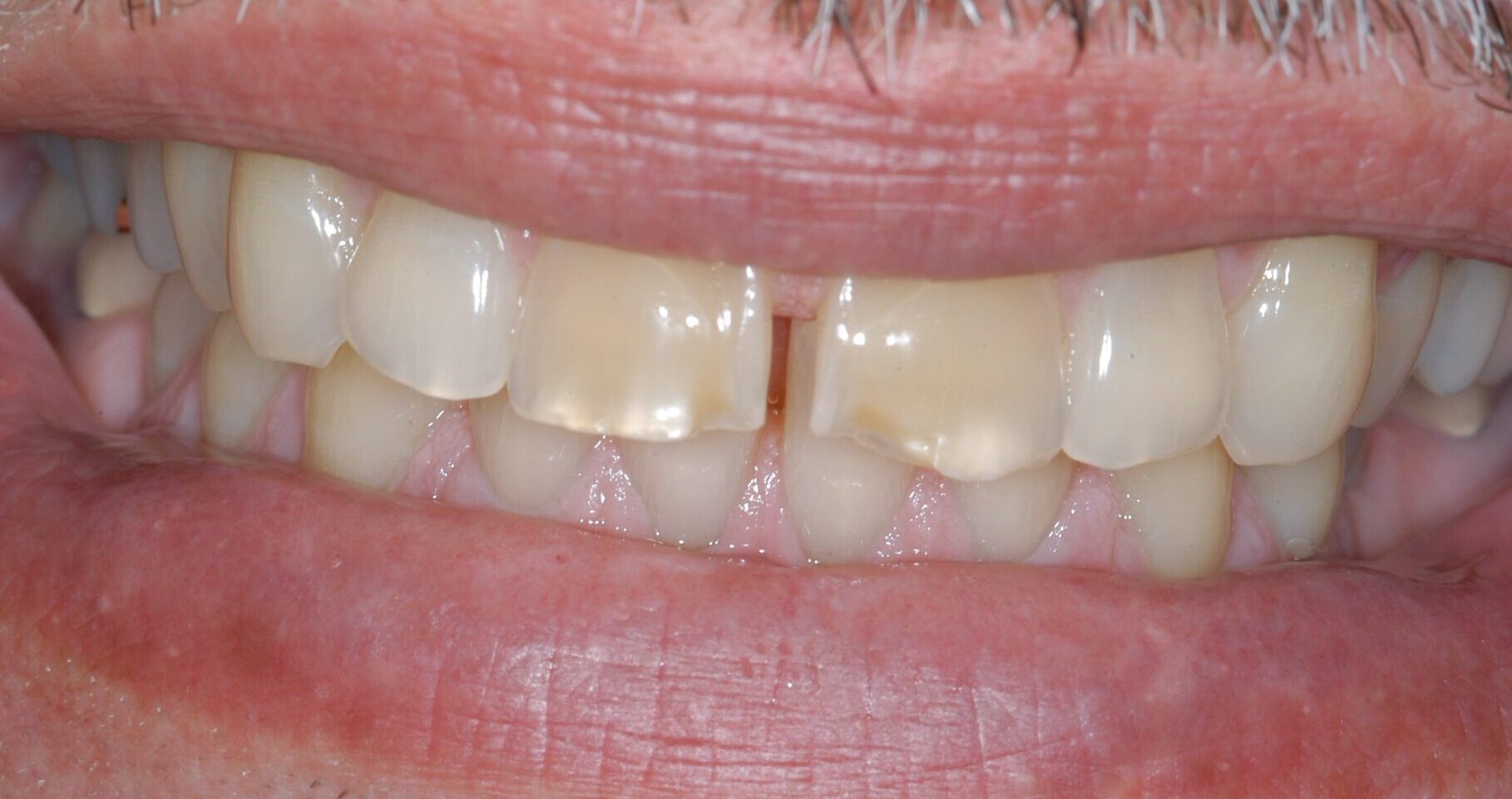 2de3f28b-517d-4d35-b68c-0700c30eb0d4-0-2before___after_photos-Alan-Carrico-(1)