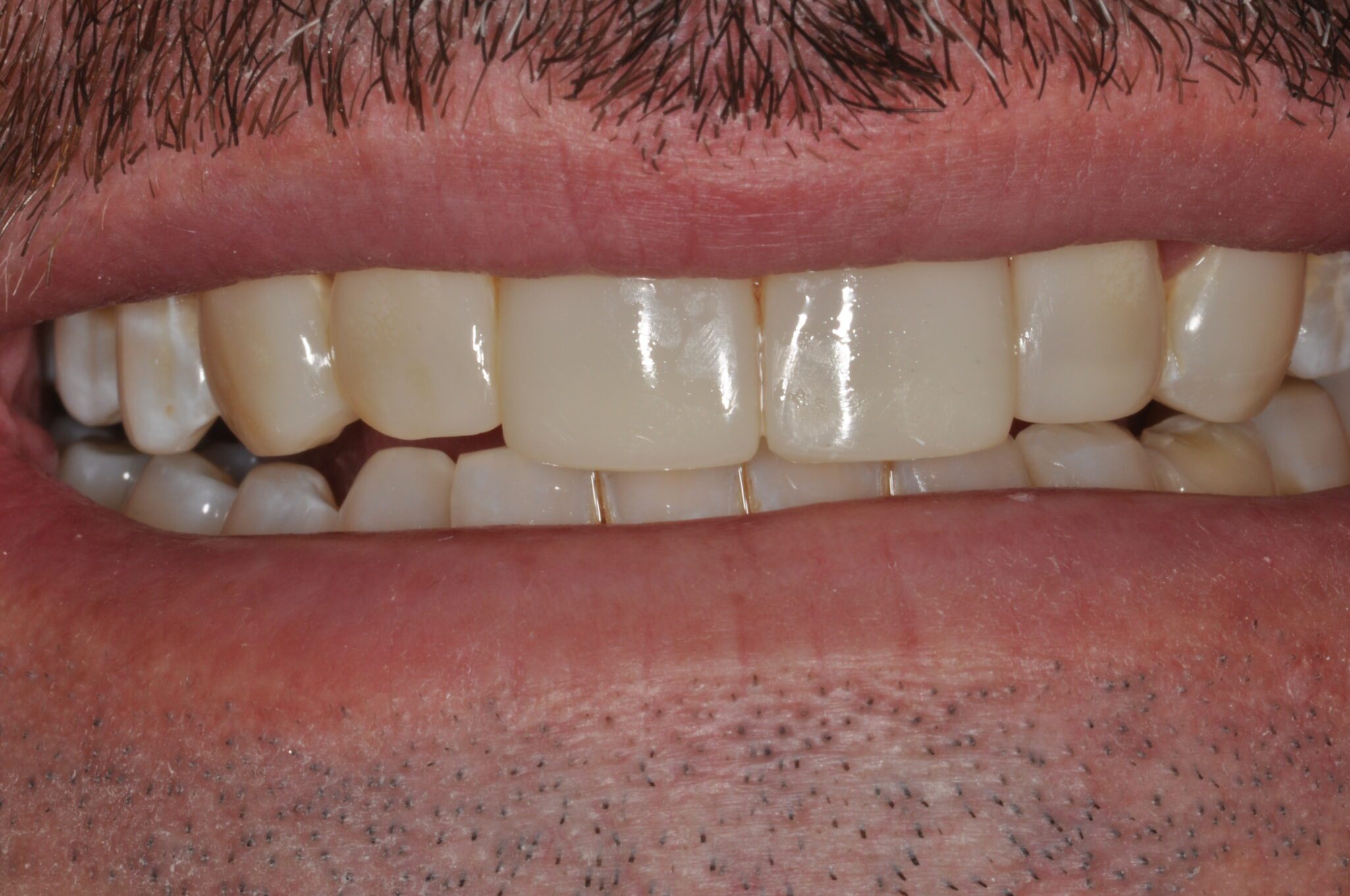 2de3f28b-517d-4d35-b68c-0700c30eb0d4-0-2before___after_photos-DSC_0153