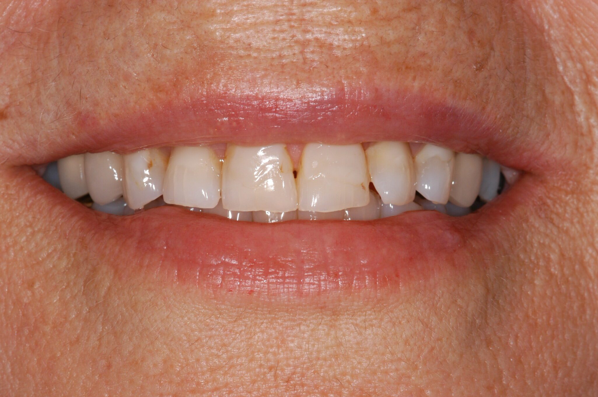 2de3f28b-517d-4d35-b68c-0700c30eb0d4-0-2before___after_photos-Odette-Johnson-pre-(5)